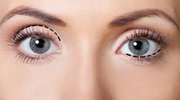 La blépharoplastie esthétique