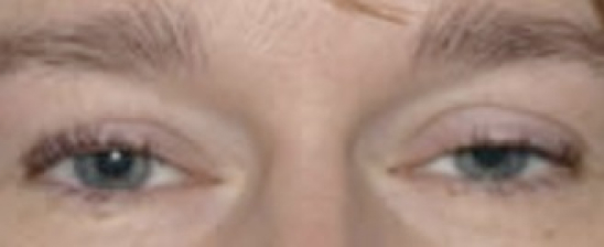  malposition de paupière Ptosis Liége